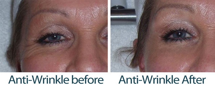 anti wrinkle treatment before and after
