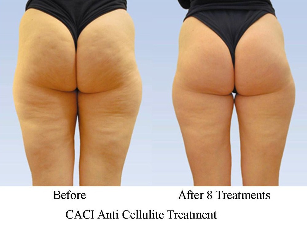 caci anti cellulite treatment before and after
