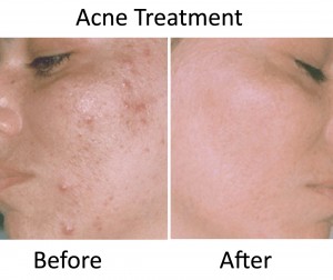 acne treatment before and after