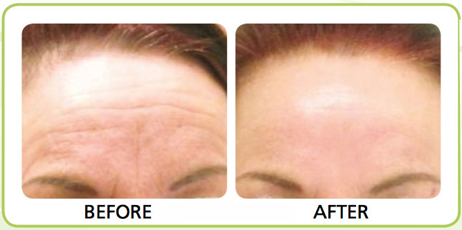 anti wrinkle treatment before and after