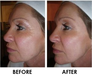 anti wrinkle treatment before and after