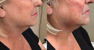 CACI JOWL LIFT