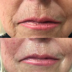 CACI LIP TREATMENT